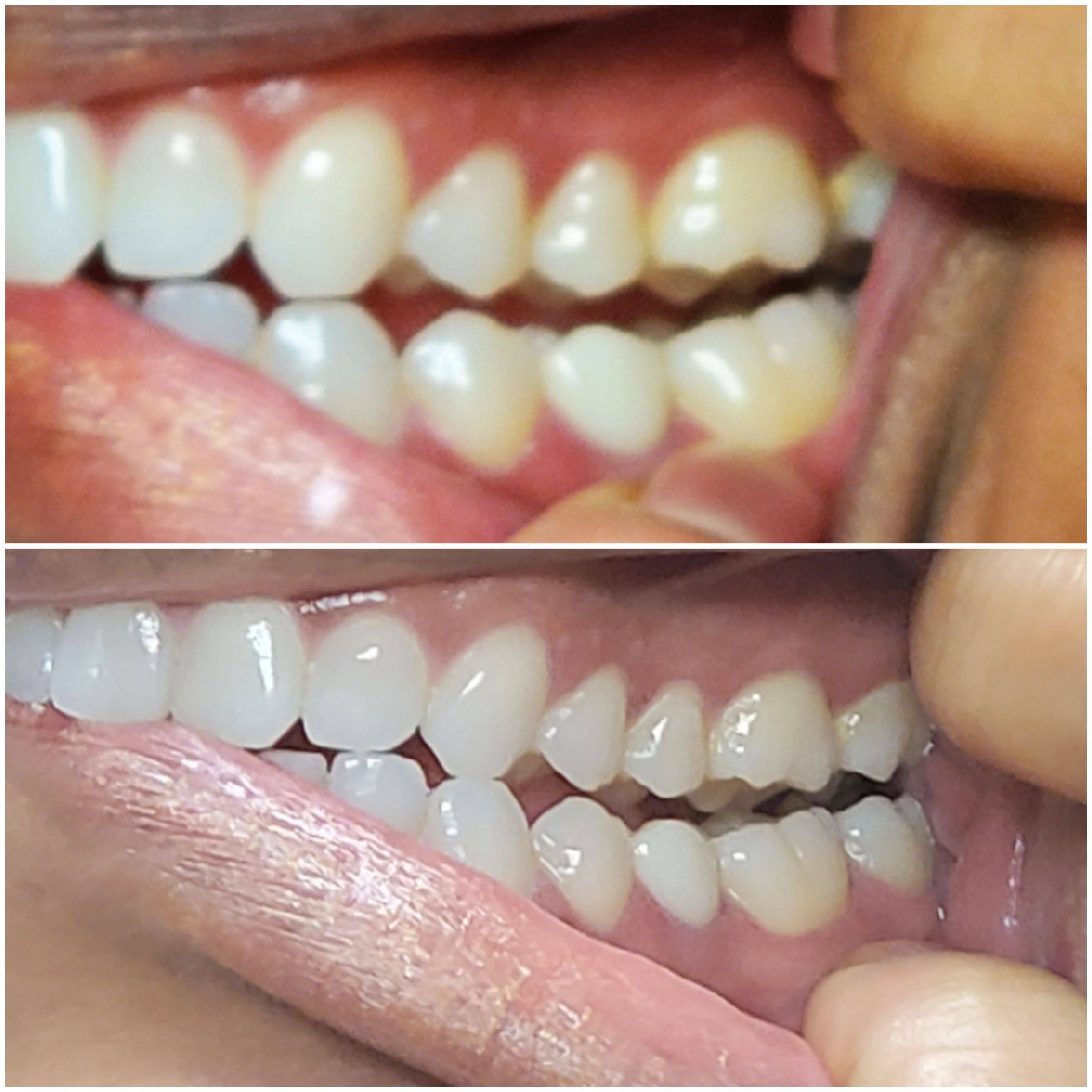 Tru Vixxn Pheromone: Tru Teeth Whitening Kit - Your Dazzling Smile Starts Here