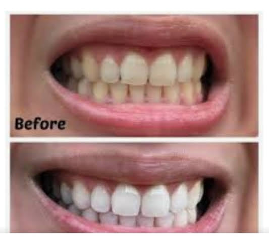 Tru Vixxn Pheromone: Tru Teeth Whitening Kit - Your Dazzling Smile Starts Here