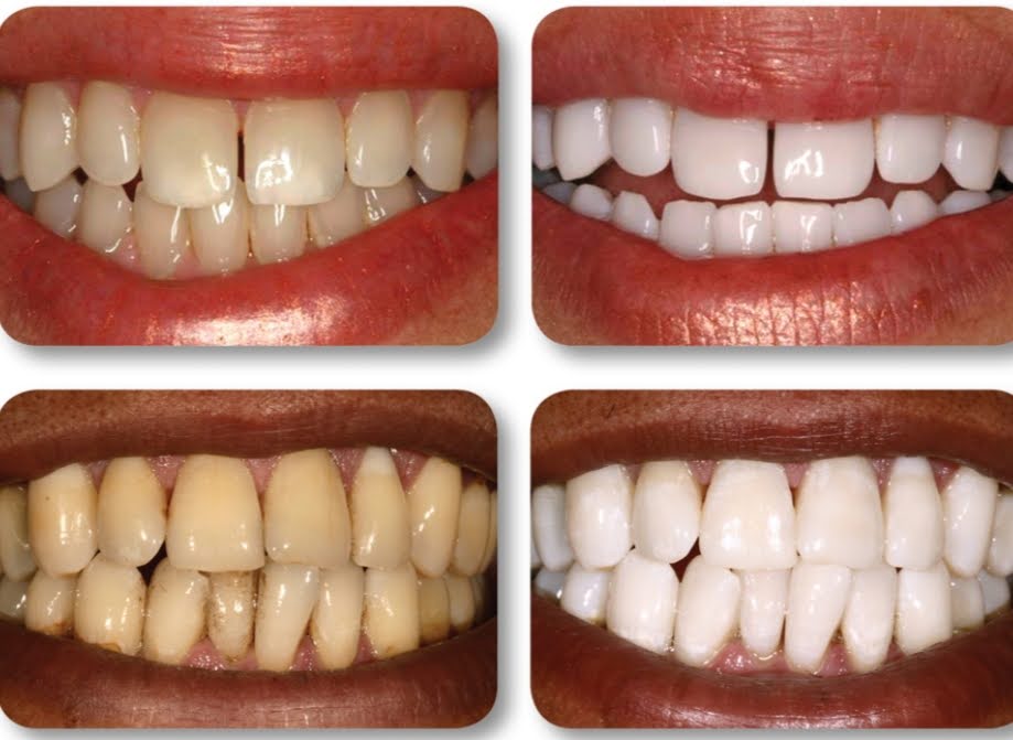 Tru Vixxn Pheromone: Tru Teeth Whitening Kit - Your Dazzling Smile Starts Here