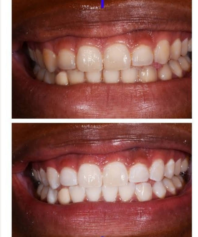 Tru Vixxn Pheromone: Tru Teeth Whitening Kit - Your Dazzling Smile Starts Here