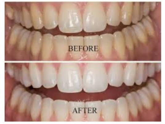 Tru Vixxn Pheromone: Tru Teeth Whitening Kit - Your Dazzling Smile Starts Here