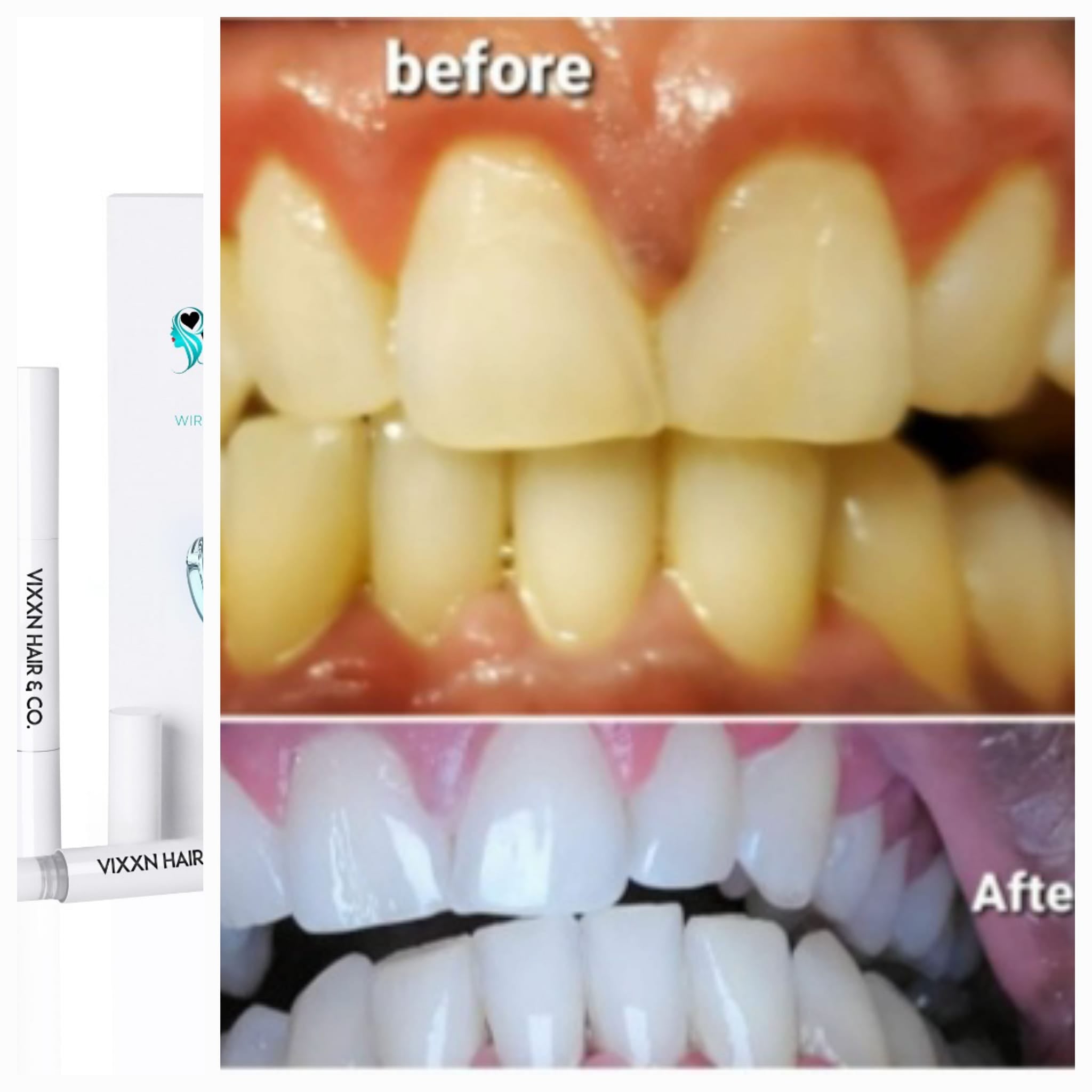 Tru Vixxn Pheromone: Tru Teeth Whitening Kit - Your Dazzling Smile Starts Here